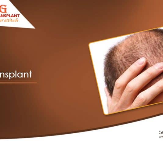 Hair transplants for women in India