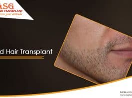 Getting a Beard Hair Transplant to become trendy