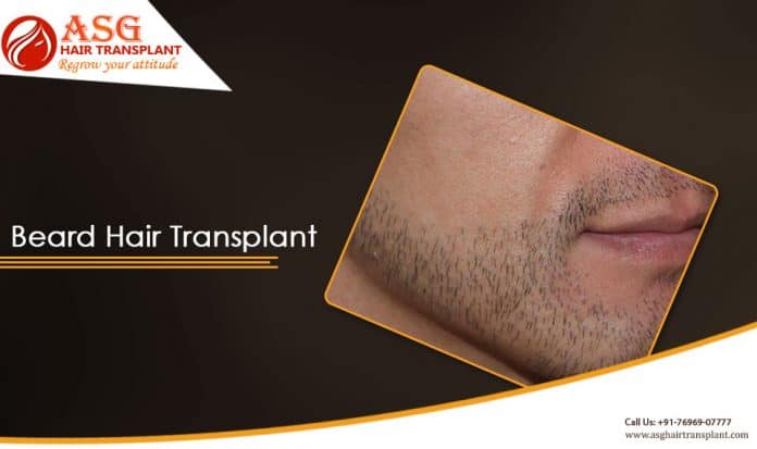 Getting a Beard Hair Transplant to become trendy