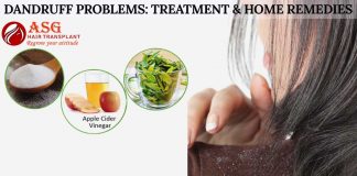 Dandruff Problems: Treatment & Home Remedies