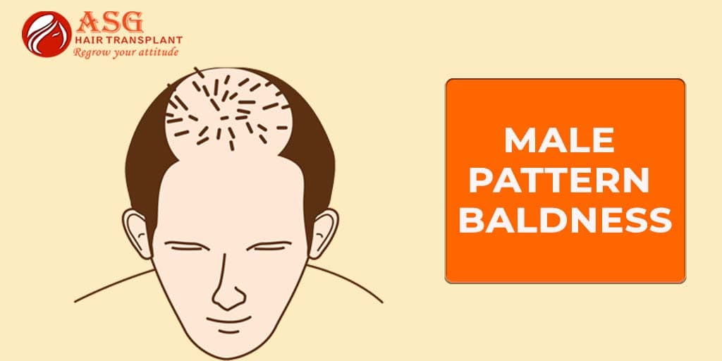 Male Pattern Baldness 