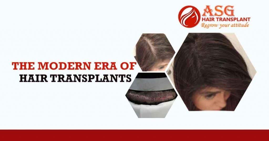 The Modern Era Of Hair Transplants