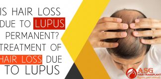 Is Hair loss Due To Lupus Permanent Treatment of Hair loss Due to Lupus
