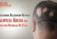 Understanding Relationship Between Alopecia Areata And Infection Outbreaks On Teeth