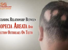 Understanding Relationship Between Alopecia Areata And Infection Outbreaks On Teeth