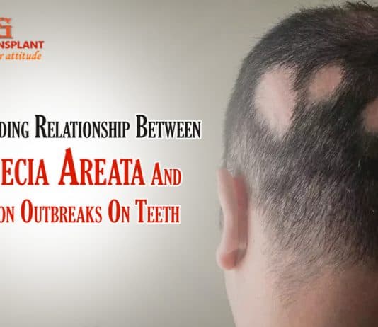 Understanding Relationship Between Alopecia Areata And Infection Outbreaks On Teeth