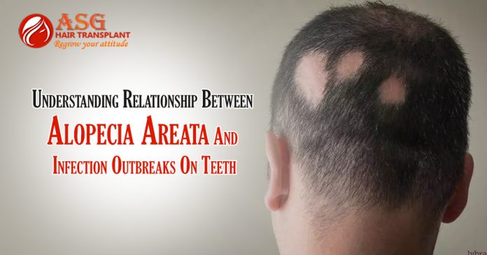 Understanding Relationship Between Alopecia Areata And Infection Outbreaks On Teeth