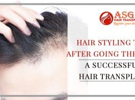 Hair Styling Tips after Going through a sucessfull hair transplant
