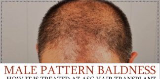 Male pattern Baldness - How it is treated at ASG hair Transplant