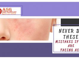 Never Do These mistakes if you are facing acne