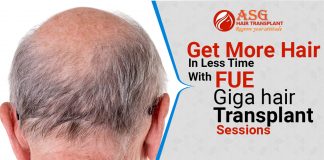 Get More Hair In Less Time With FUE Giga hair Transplant Sessions