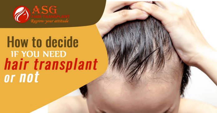 How to decide if you need hair transplant or not