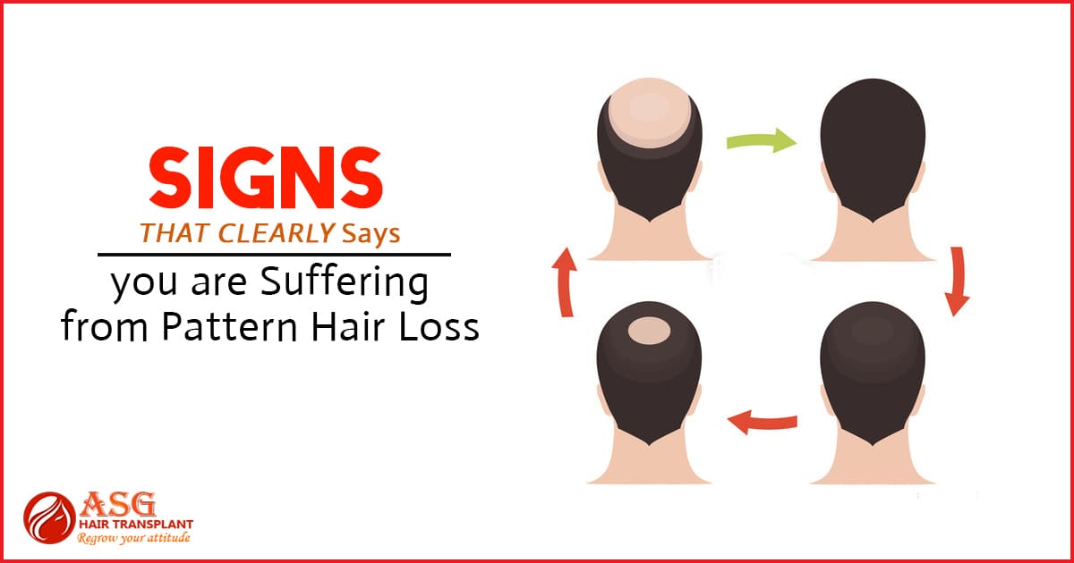 Signs of Pattern Hair Loss