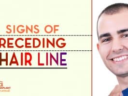 Signs of Receding Hair Line