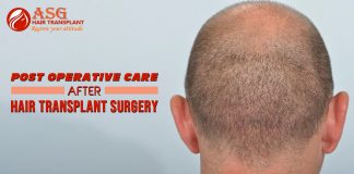 Post operative Care After Hair Transplant Surgery