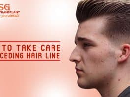 Tips to Take Care of Receding Hair line