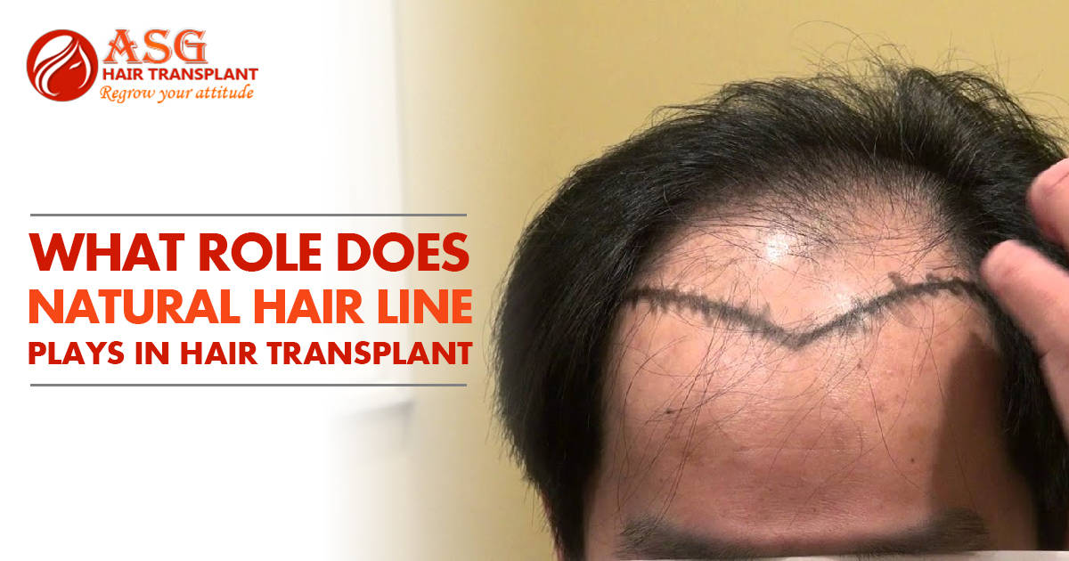 Natural Hair Line's Role in Hair Transplant