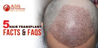 5 Hair Transplant Facts & FAQs