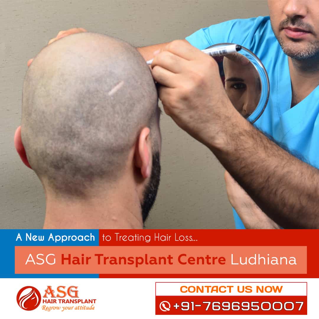 Hair Transplant in Ludhiana Moga Jagraon Punjab  Hair Transplant Cost  in Amritsar Jalandhar Punjab
