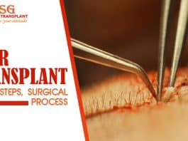 Hair Transplant - Facts, Steps, Surgical Process 