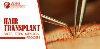 Hair Transplant - Facts, Steps, Surgical Process 