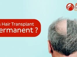 Is hair transplant permanent copy