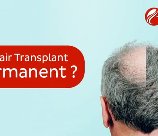 Is hair transplant permanent copy
