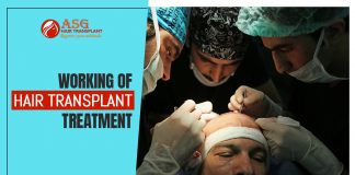 Working of hair transplant treatment