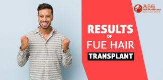 Results of FUE hair transplant