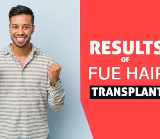 Results of FUE hair transplant