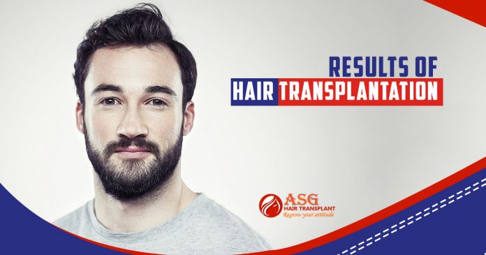 Results of hair transplantation