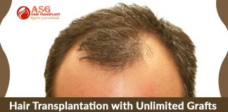 Hair Transplantation with Unlimited Grafts