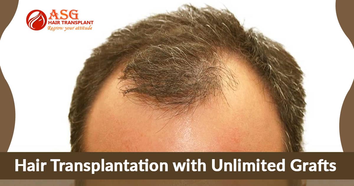 Hair Transplantation with Unlimited Grafts