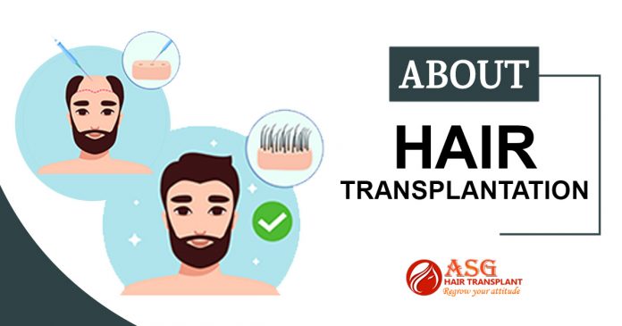 About hair transplantation Punjab
