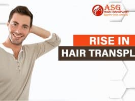 Rise in Hair Transplant