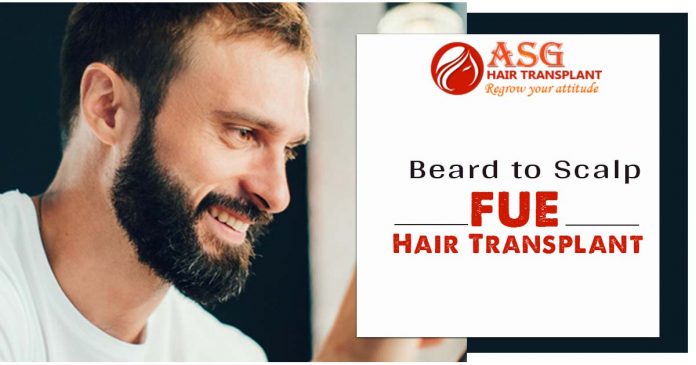 Beard to Scalp FUE Hair Transplant