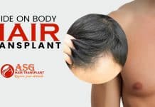 Guide on body hair transplant