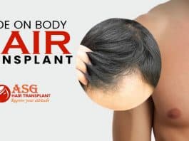 Guide on body hair transplant