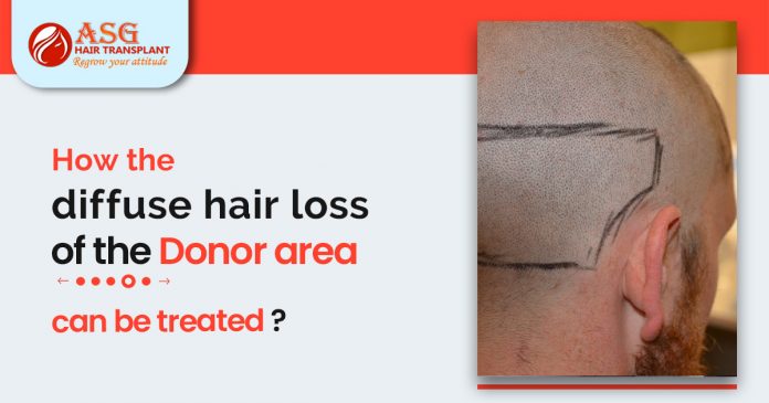 the diffuse hair loss of the donor area can be treated