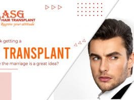 hair transplant done before the marriage
