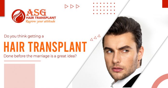 hair transplant done before the marriage