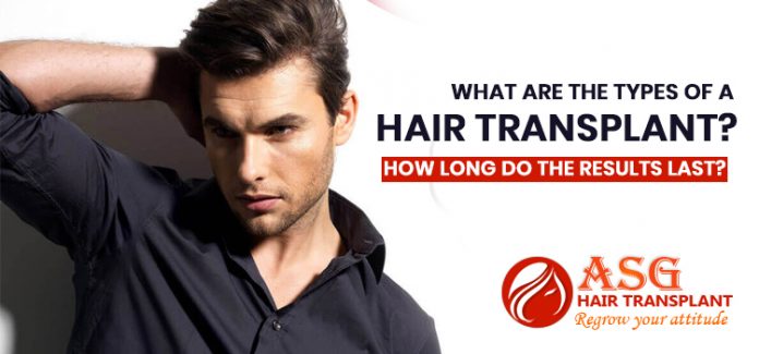 What-are-the-types-of-a-hair-transplant-How-long-do-the-results-last