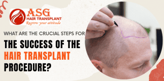 What are the crucial steps for the success of the hair transplant procedure?