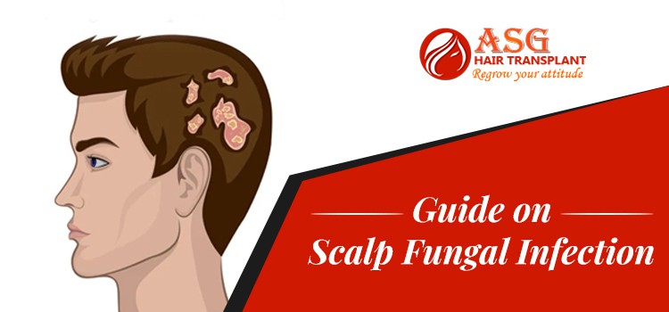 How can scalp fungal infection trigger hair loss? Which is the best  treatment? | asg blog