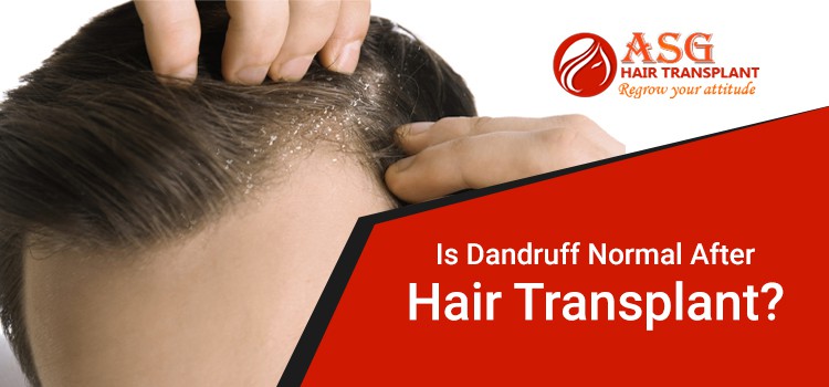 Is it normal to have dandruff after hair transplant treatment? | asg blog