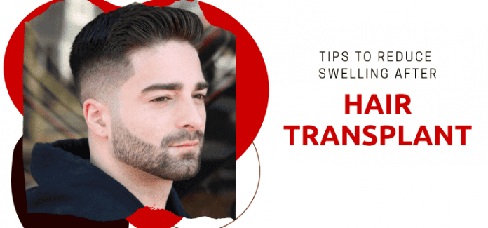 Tips to reduce swelling after hair transplant