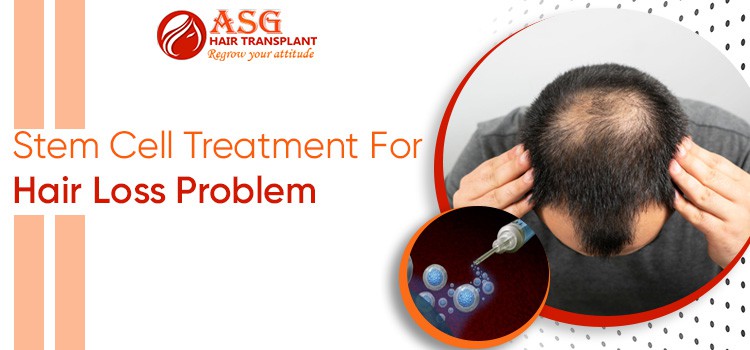 Things You Should Know About Stem Cell Treatment For Hair Fall