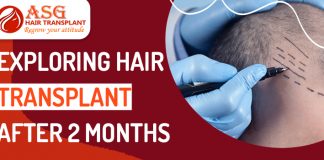 Exploring-Hair-Transplant-After-2-Months