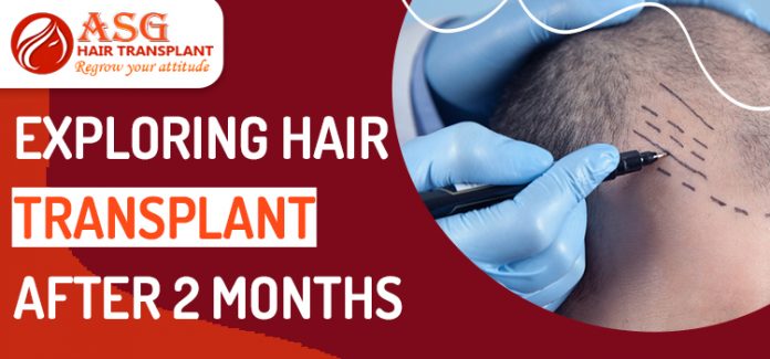 Hair Transplant Before and After Results–Dr. Berman–ARTAS® Robotic Hair  Restoration