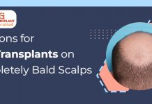 Solutions-for-Hair-Transplants-on-Completely-Bald-Scalps